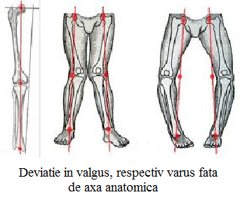 Gonartroza 1-2 grade ale tratamentului articulației genunchiului