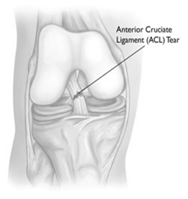 Afecțiuni ale genunchiului » Dr. Predescu